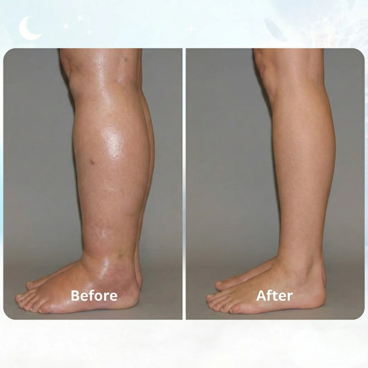 EMS Fix Restless Legs & Swelling Relief